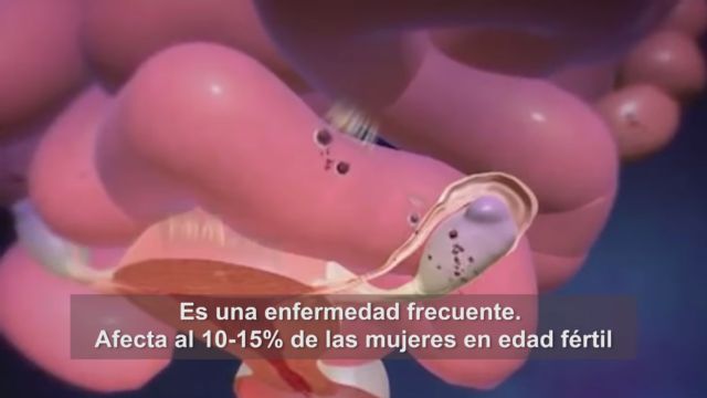 Más de 10.000 euros recaudados para estudiar la endometriosis